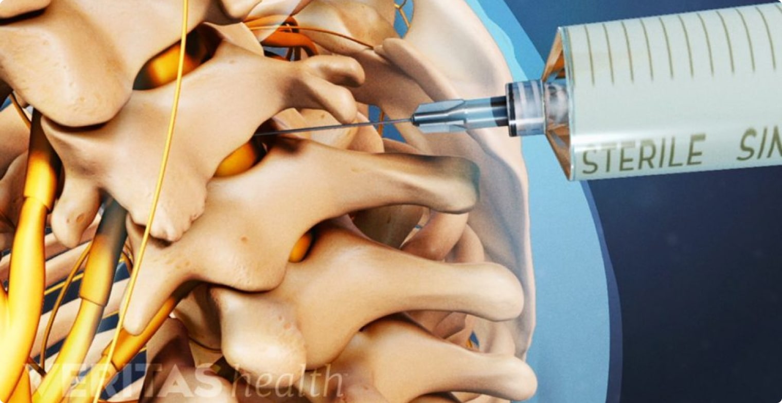 Epidural Steroid Injections Schaumburg