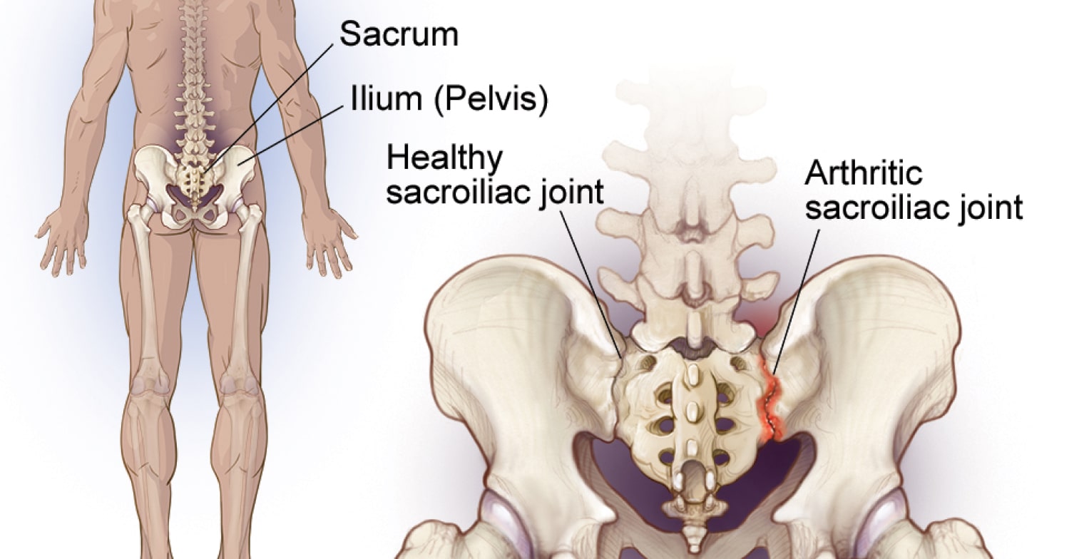 CCHI, sacroiliitis, pelvis, ilium
