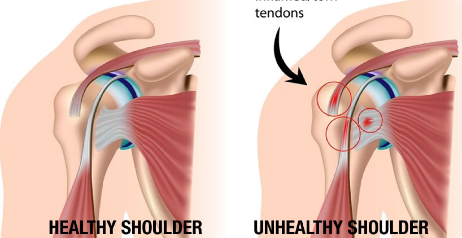 Shoulder Joint Injections Chicago