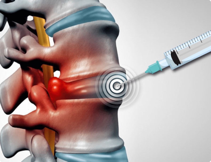 Epidural Steroid Injections Chicago